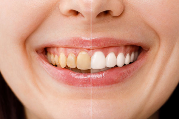 difference in tooth whitening
